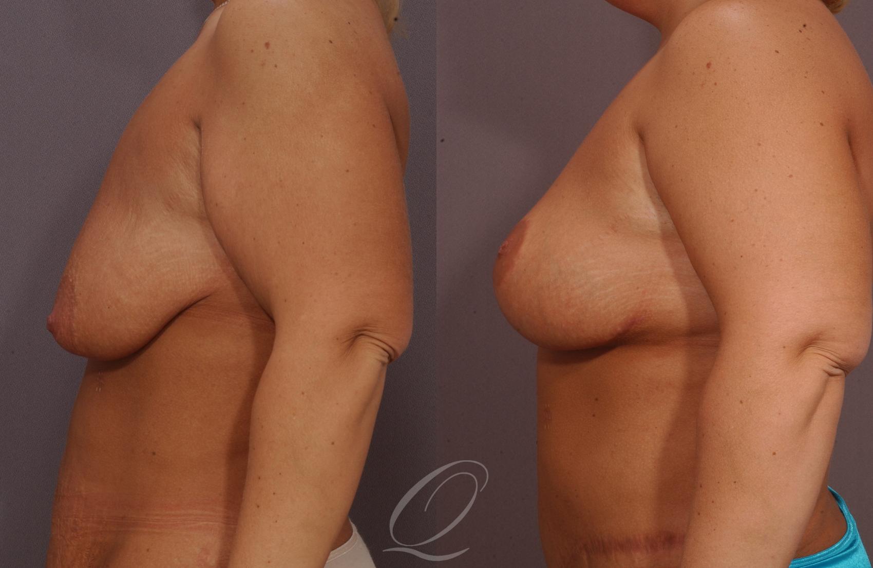 Breast Lift Case 29 Before & After View #3 | Serving Rochester, Syracuse & Buffalo, NY | Quatela Center for Plastic Surgery