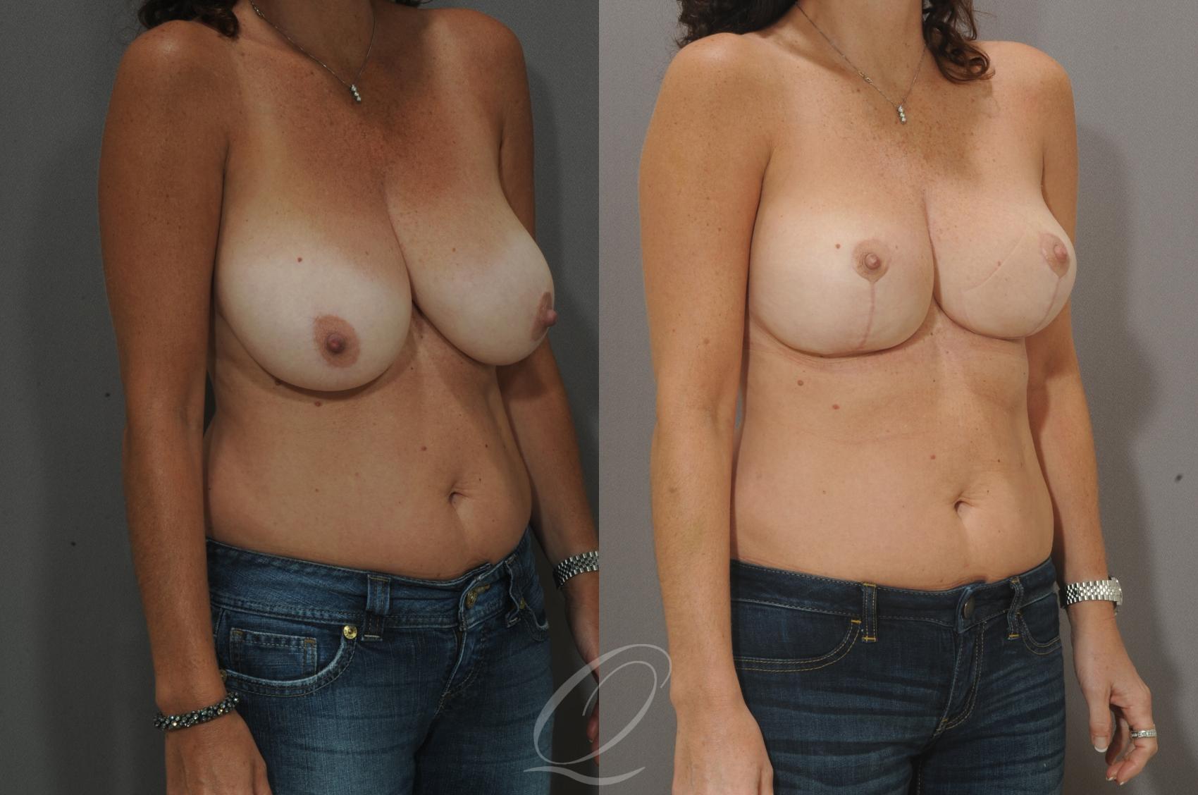 Breast Lift Case 30 Before & After View #2 | Serving Rochester, Syracuse & Buffalo, NY | Quatela Center for Plastic Surgery