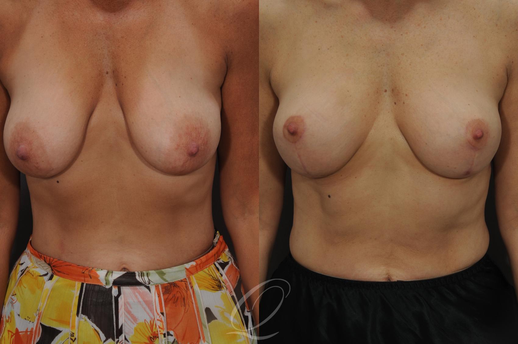 Breast Lift Case 33 Before & After View #1 | Serving Rochester, Syracuse & Buffalo, NY | Quatela Center for Plastic Surgery