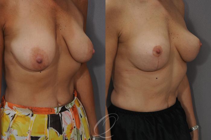 Breast Lift Case 33 Before & After View #2 | Serving Rochester, Syracuse & Buffalo, NY | Quatela Center for Plastic Surgery