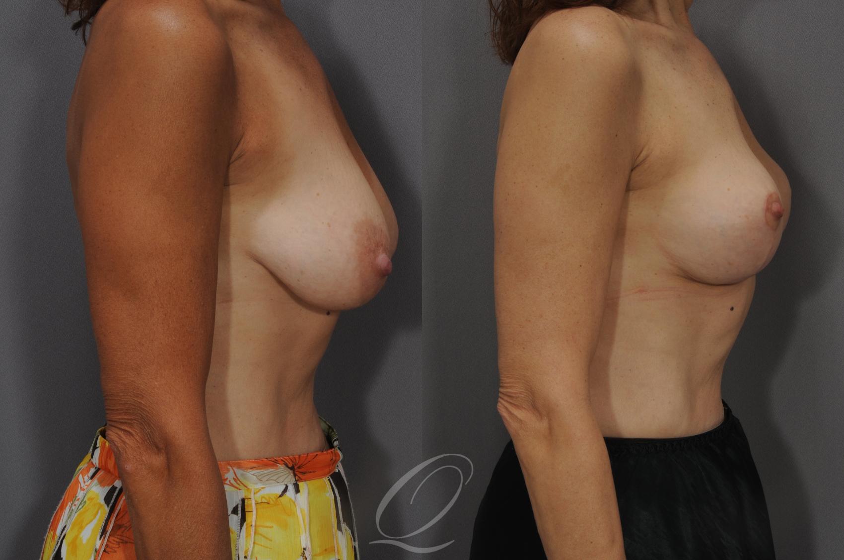 Breast Lift Case 33 Before & After View #3 | Serving Rochester, Syracuse & Buffalo, NY | Quatela Center for Plastic Surgery