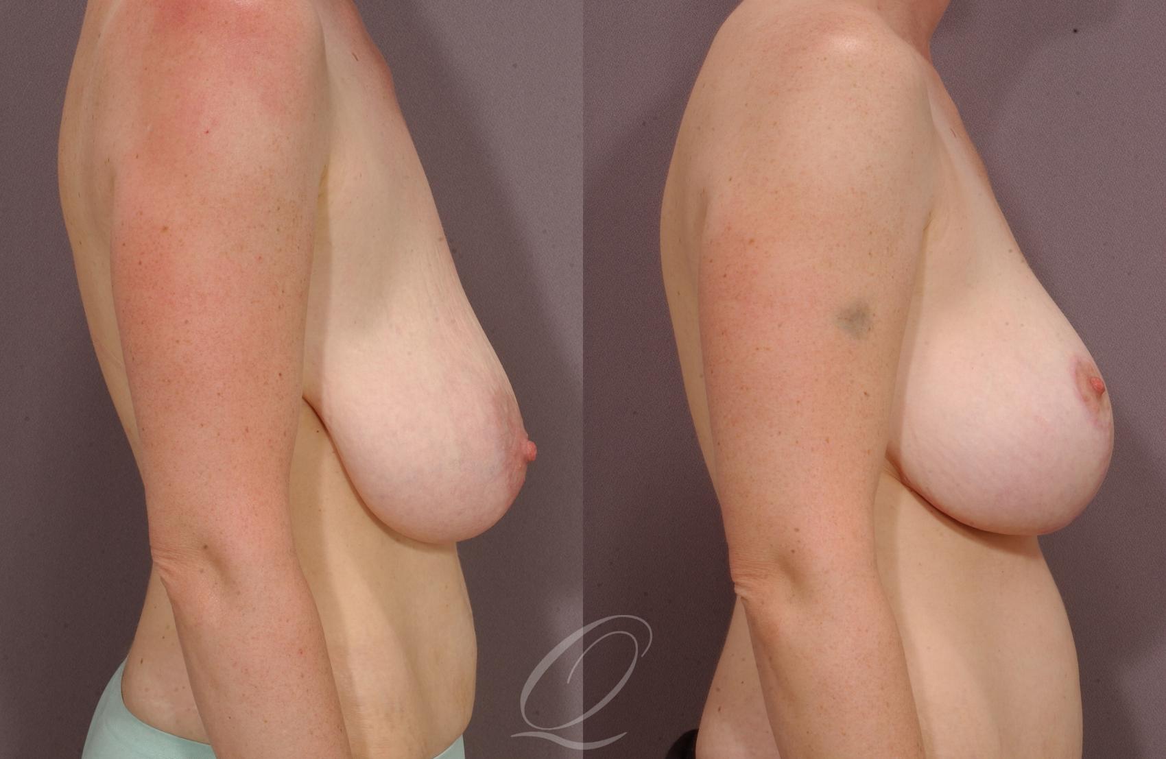 Breast Lift Case 35 Before & After View #3 | Serving Rochester, Syracuse & Buffalo, NY | Quatela Center for Plastic Surgery