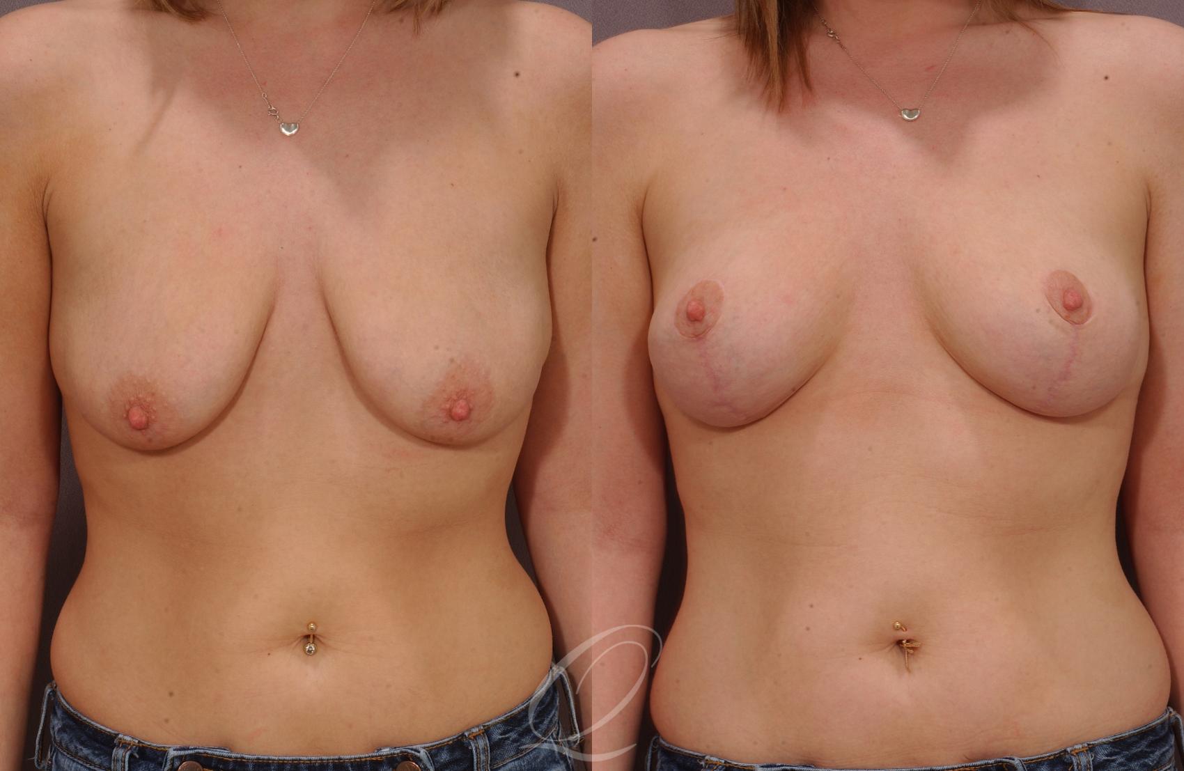 Breast Lift Case 36 Before & After View #1 | Serving Rochester, Syracuse & Buffalo, NY | Quatela Center for Plastic Surgery