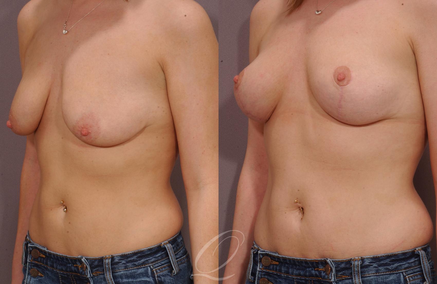 Breast Lift Case 36 Before & After View #2 | Serving Rochester, Syracuse & Buffalo, NY | Quatela Center for Plastic Surgery