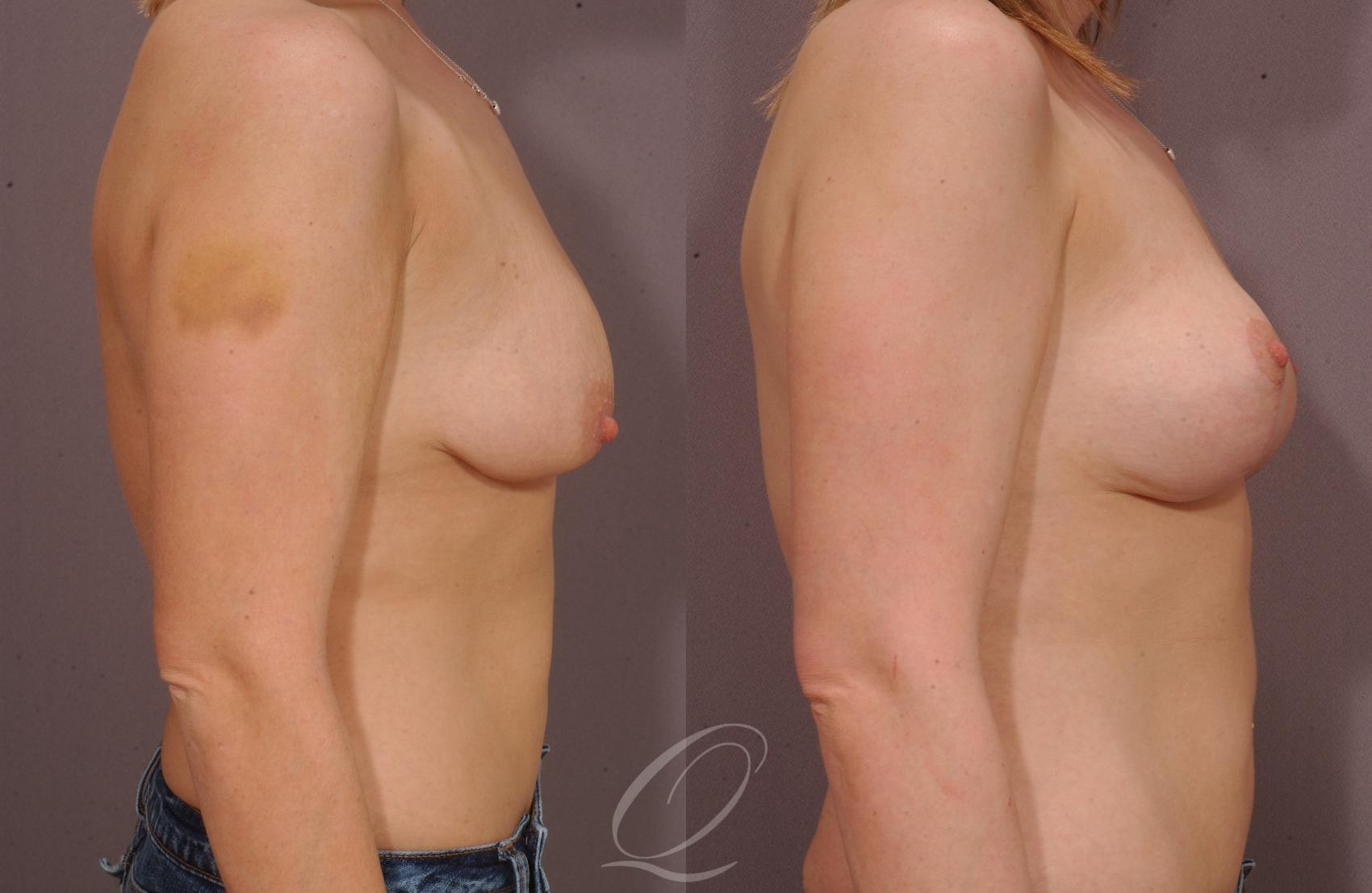Breast Lift Case 36 Before & After View #3 | Serving Rochester, Syracuse & Buffalo, NY | Quatela Center for Plastic Surgery