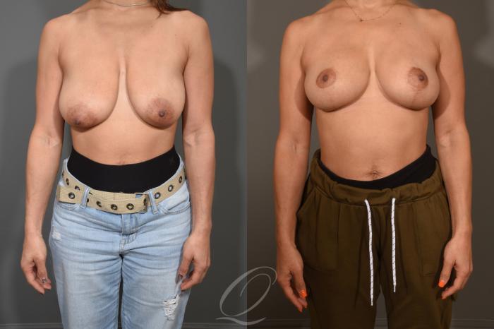 Breast Lift Case 386 Before & After View #1 | Serving Rochester, Syracuse & Buffalo, NY | Quatela Center for Plastic Surgery