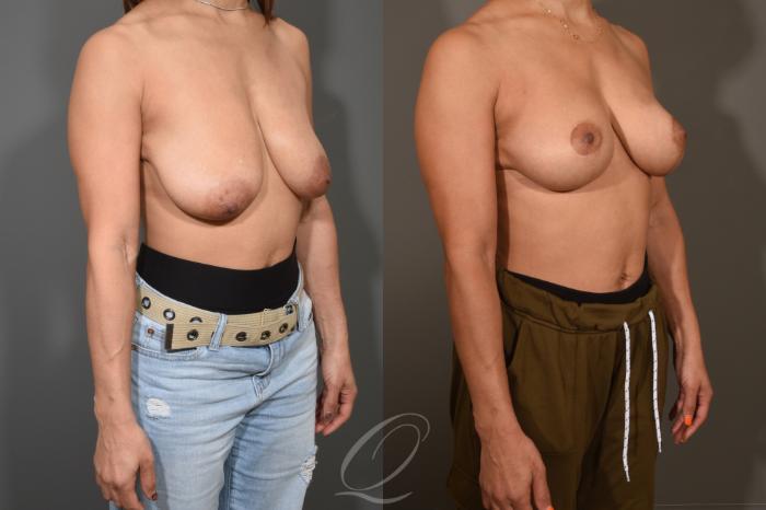 Breast Lift Case 386 Before & After View #2 | Serving Rochester, Syracuse & Buffalo, NY | Quatela Center for Plastic Surgery
