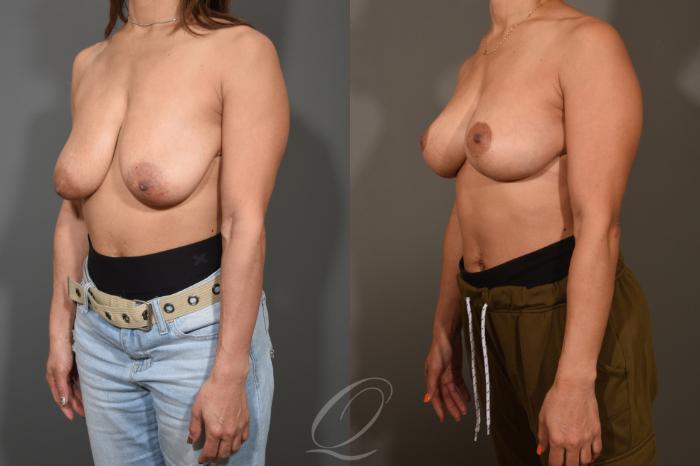 Breast Lift Case 386 Before & After View #4 | Serving Rochester, Syracuse & Buffalo, NY | Quatela Center for Plastic Surgery