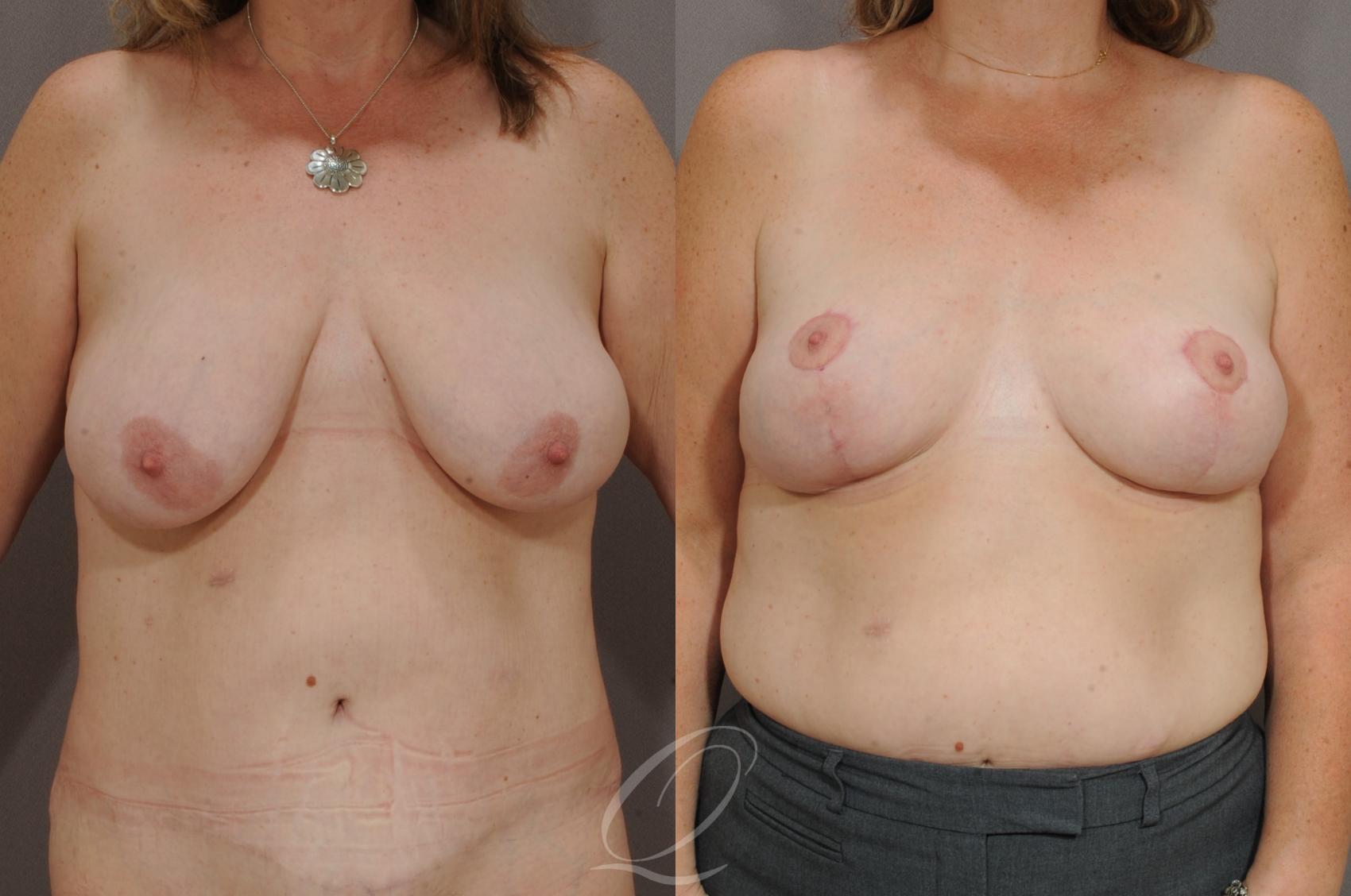 Breast Lift Case 39 Before & After View #1 | Serving Rochester, Syracuse & Buffalo, NY | Quatela Center for Plastic Surgery