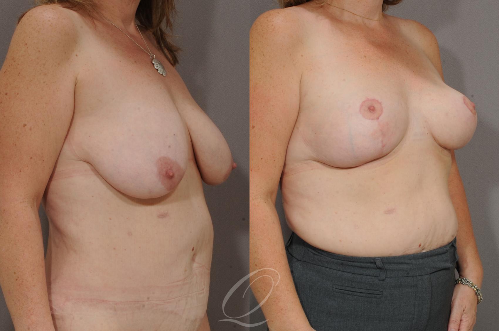 Breast Lift Case 39 Before & After View #2 | Serving Rochester, Syracuse & Buffalo, NY | Quatela Center for Plastic Surgery