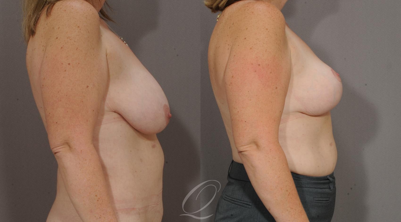 Breast Lift Case 39 Before & After View #3 | Serving Rochester, Syracuse & Buffalo, NY | Quatela Center for Plastic Surgery