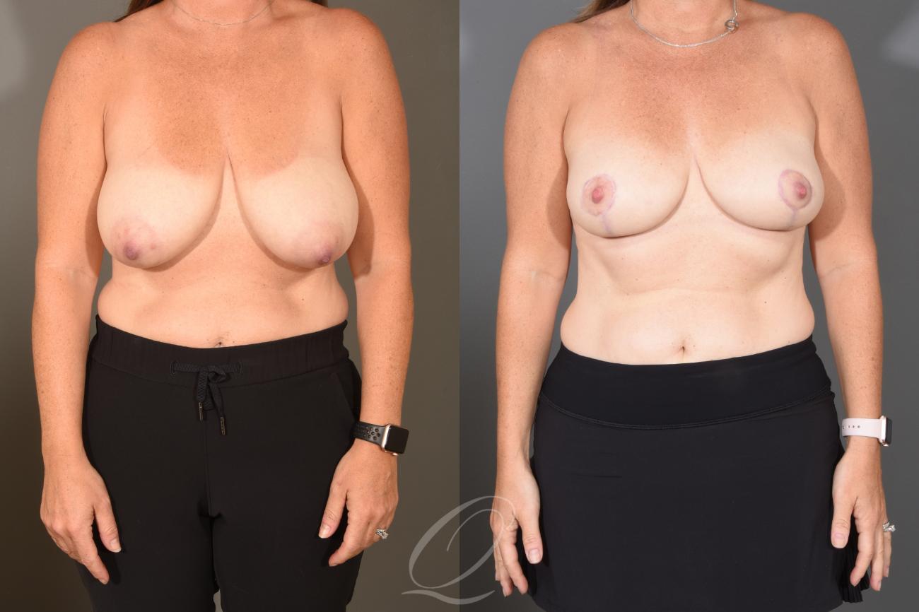 Breast Lift Case 1488 Before & After Front | Serving Rochester, Syracuse & Buffalo, NY | Quatela Center for Plastic Surgery
