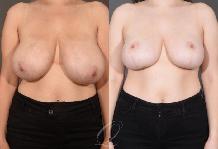 Breast Reduction Case 1001505 Before & After Front | Serving Rochester, Syracuse & Buffalo, NY | Quatela Center for Plastic Surgery