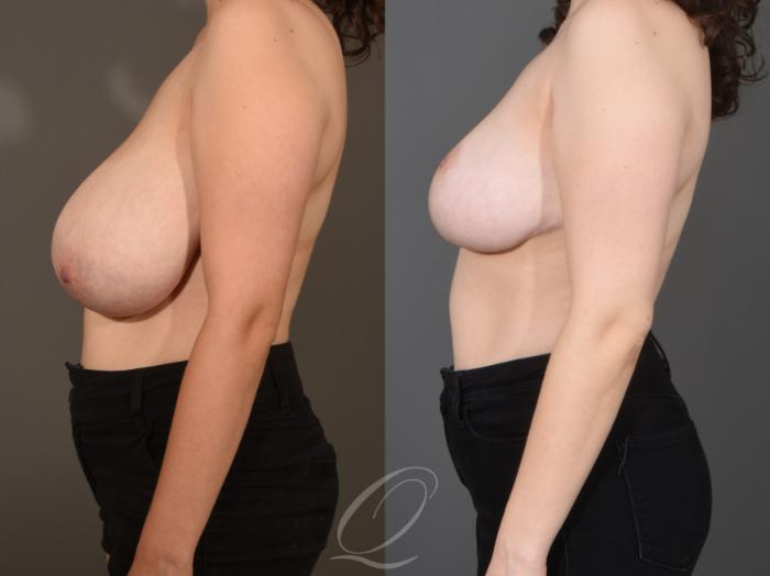 Breast Reduction Case 1001505 Before & After Left Side | Serving Rochester, Syracuse & Buffalo, NY | Quatela Center for Plastic Surgery