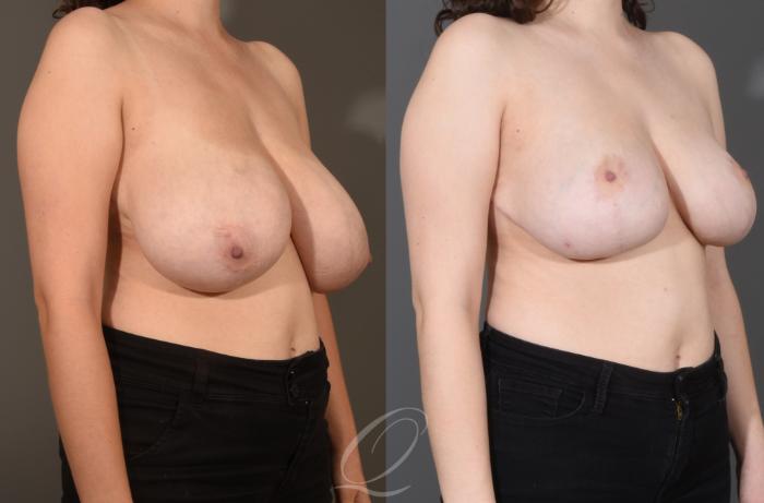 Breast Reduction Case 1001505 Before & After Right Oblique | Serving Rochester, Syracuse & Buffalo, NY | Quatela Center for Plastic Surgery