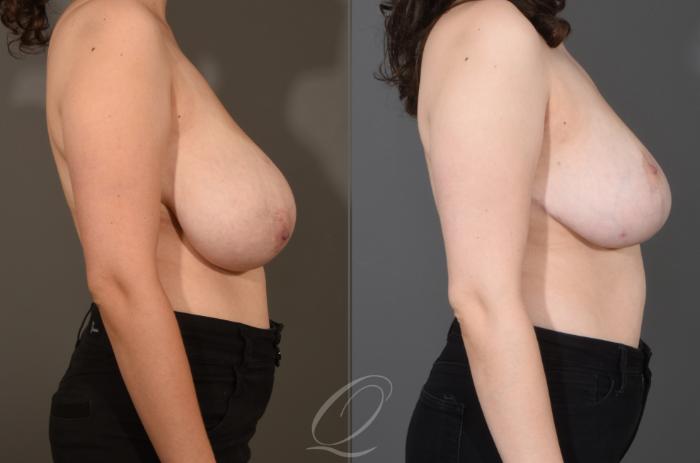 Breast Reduction Case 1001505 Before & After Right Side | Serving Rochester, Syracuse & Buffalo, NY | Quatela Center for Plastic Surgery