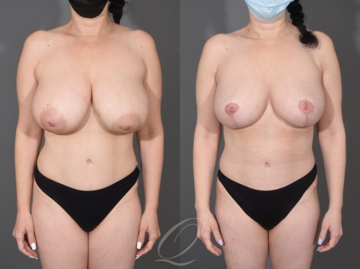 Liposuction Case 1001622 Before & After Front | Serving Rochester, Syracuse & Buffalo, NY | Quatela Center for Plastic Surgery