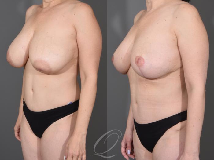 Liposuction Case 1001622 Before & After Left Oblique | Serving Rochester, Syracuse & Buffalo, NY | Quatela Center for Plastic Surgery