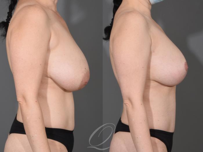 Liposuction Case 1001622 Before & After Right Side | Serving Rochester, Syracuse & Buffalo, NY | Quatela Center for Plastic Surgery