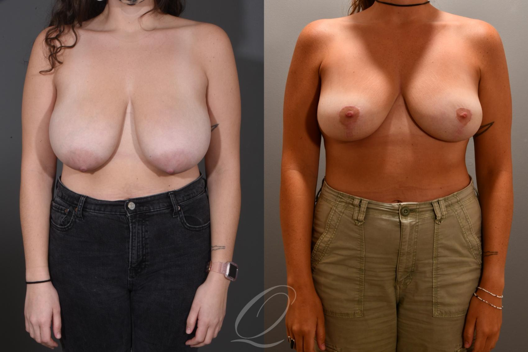 Breast Lift Case 1001719 Before & After Front | Serving Rochester, Syracuse & Buffalo, NY | Quatela Center for Plastic Surgery