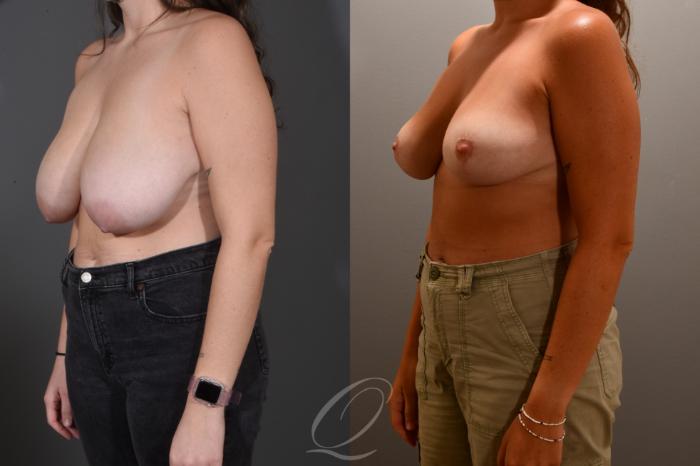 Breast Reduction Case 1001719 Before & After Left Oblique | Serving Rochester, Syracuse & Buffalo, NY | Quatela Center for Plastic Surgery