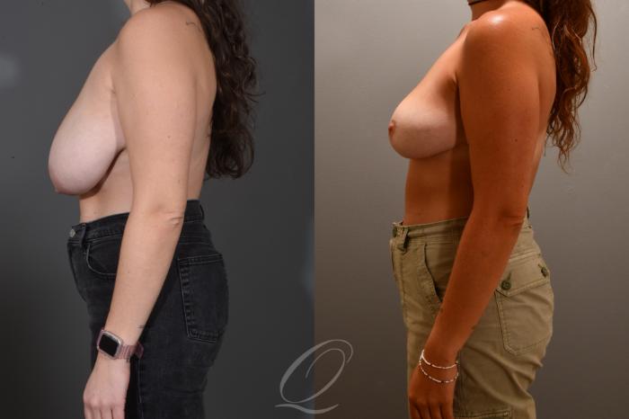 Breast Reduction Case 1001719 Before & After Left Side | Serving Rochester, Syracuse & Buffalo, NY | Quatela Center for Plastic Surgery