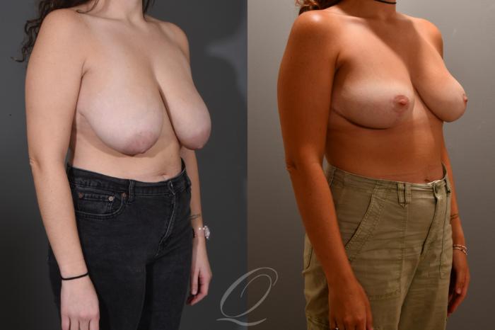 Breast Reduction Case 1001719 Before & After Right Oblique | Serving Rochester, Syracuse & Buffalo, NY | Quatela Center for Plastic Surgery