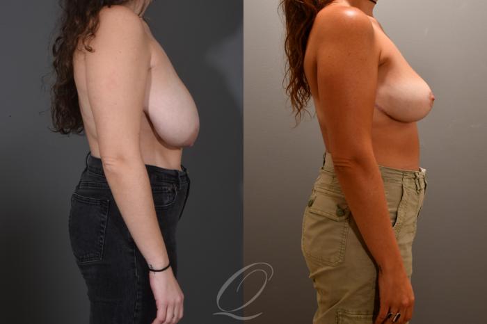 Breast Reduction Case 1001719 Before & After Right Side | Serving Rochester, Syracuse & Buffalo, NY | Quatela Center for Plastic Surgery