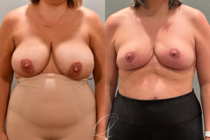 Breast Reduction Case 1001803 Before & After Front | Serving Rochester, Syracuse & Buffalo, NY | Quatela Center for Plastic Surgery