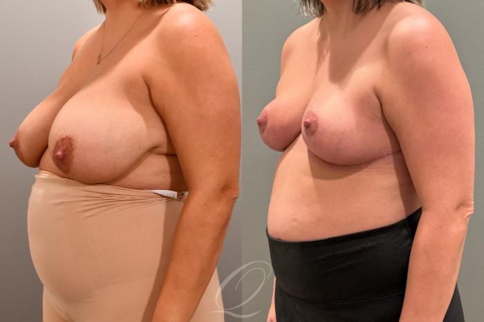 Breast Reduction Case 1001803 Before & After Left Oblique | Serving Rochester, Syracuse & Buffalo, NY | Quatela Center for Plastic Surgery