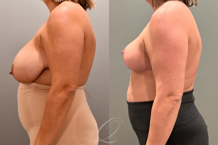 Breast Reduction Case 1001803 Before & After Left Side | Serving Rochester, Syracuse & Buffalo, NY | Quatela Center for Plastic Surgery