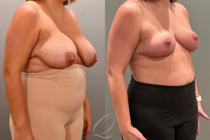 Breast Reduction Case 1001803 Before & After Right Oblique | Serving Rochester, Syracuse & Buffalo, NY | Quatela Center for Plastic Surgery