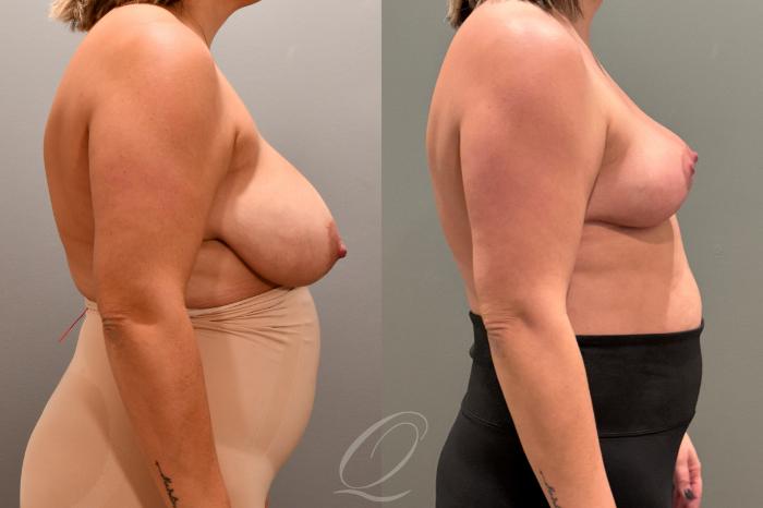 Breast Reduction Case 1001803 Before & After Right Side | Serving Rochester, Syracuse & Buffalo, NY | Quatela Center for Plastic Surgery