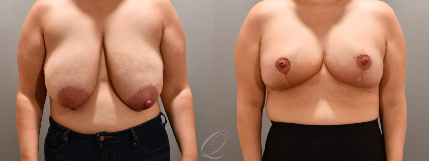 Breast Reduction Case 1001805 Before & After Front | Serving Rochester, Syracuse & Buffalo, NY | Quatela Center for Plastic Surgery