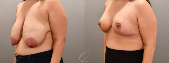 Breast Reduction Case 1001805 Before & After Left Oblique | Serving Rochester, Syracuse & Buffalo, NY | Quatela Center for Plastic Surgery