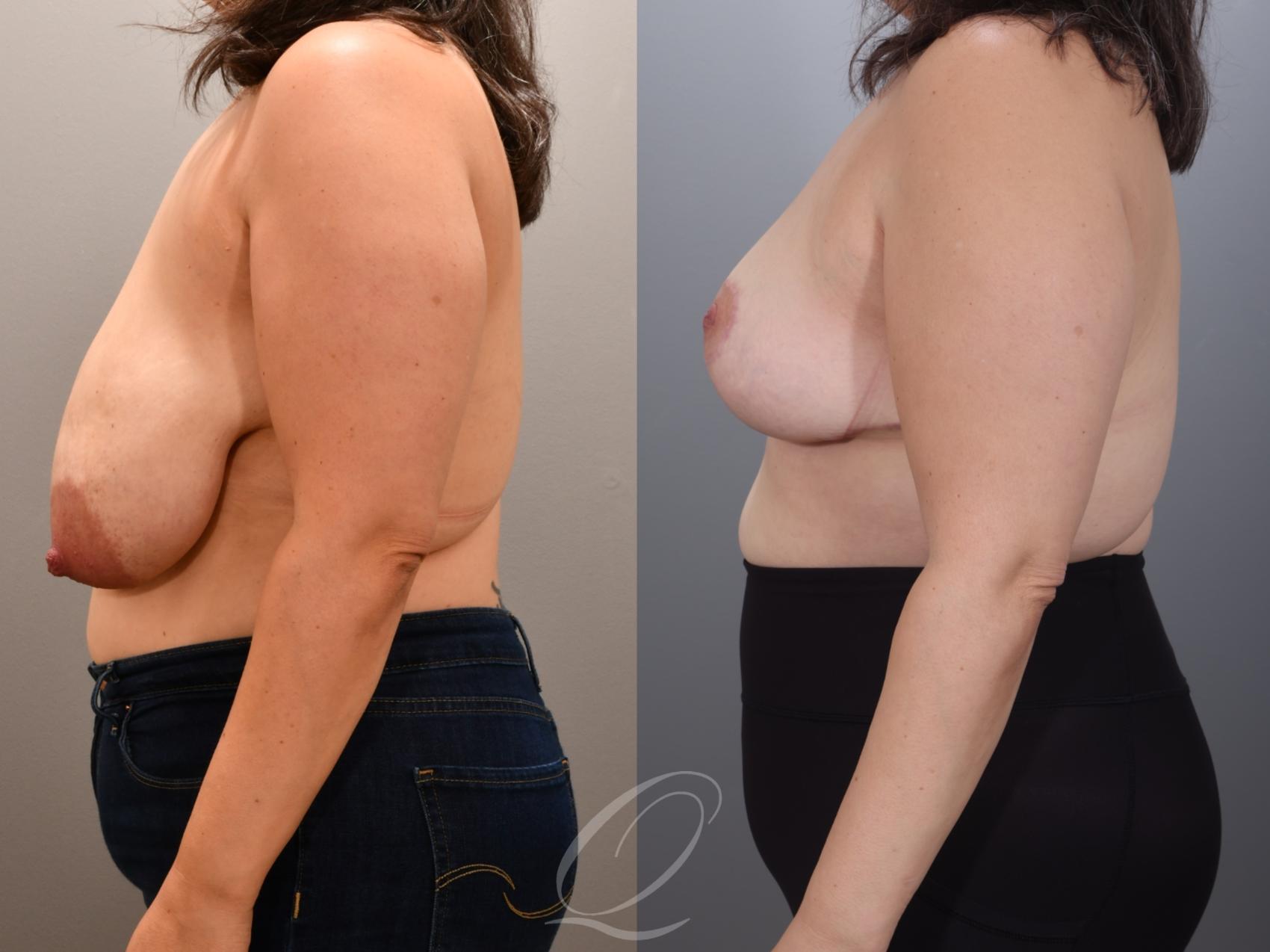 Breast Reduction Case 1001805 Before & After Left Side | Serving Rochester, Syracuse & Buffalo, NY | Quatela Center for Plastic Surgery