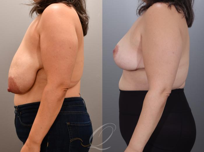 Breast Reduction Case 1001805 Before & After Left Side | Serving Rochester, Syracuse & Buffalo, NY | Quatela Center for Plastic Surgery