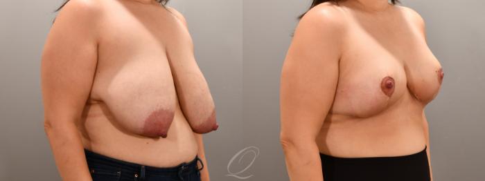 Breast Reduction Case 1001805 Before & After Right Oblique | Serving Rochester, Syracuse & Buffalo, NY | Quatela Center for Plastic Surgery