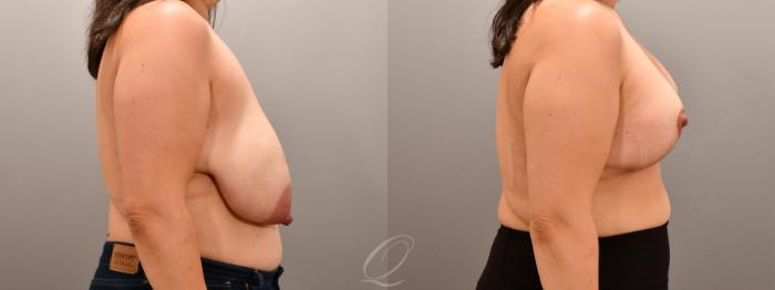 Breast Reduction Case 1001805 Before & After Right Side | Serving Rochester, Syracuse & Buffalo, NY | Quatela Center for Plastic Surgery