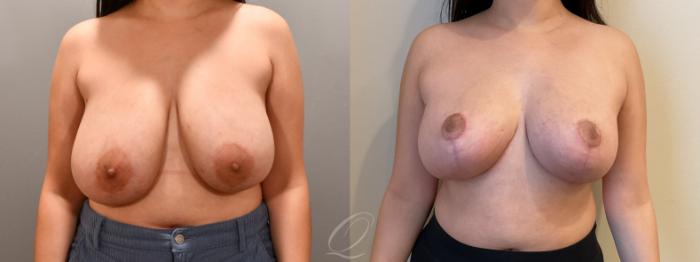 Breast Reduction Case 1001807 Before & After Front | Serving Rochester, Syracuse & Buffalo, NY | Quatela Center for Plastic Surgery