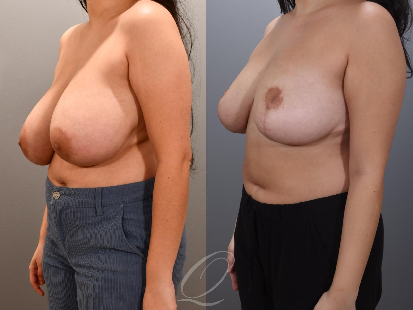 Breast Reduction Case 1001807 Before & After Left Oblique | Serving Rochester, Syracuse & Buffalo, NY | Quatela Center for Plastic Surgery