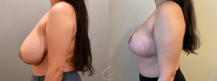 Breast Reduction Case 1001807 Before & After Left Side | Serving Rochester, Syracuse & Buffalo, NY | Quatela Center for Plastic Surgery