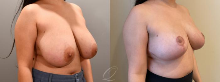 Breast Reduction Case 1001807 Before & After Right Oblique | Serving Rochester, Syracuse & Buffalo, NY | Quatela Center for Plastic Surgery