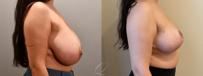 Breast Reduction Case 1001807 Before & After Right Side | Serving Rochester, Syracuse & Buffalo, NY | Quatela Center for Plastic Surgery