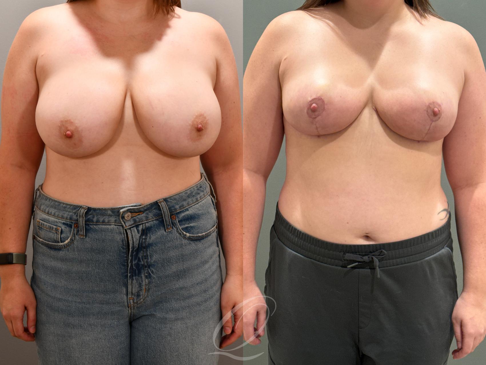 Breast Reduction Case 1001818 Before & After Front | Serving Rochester, Syracuse & Buffalo, NY | Quatela Center for Plastic Surgery