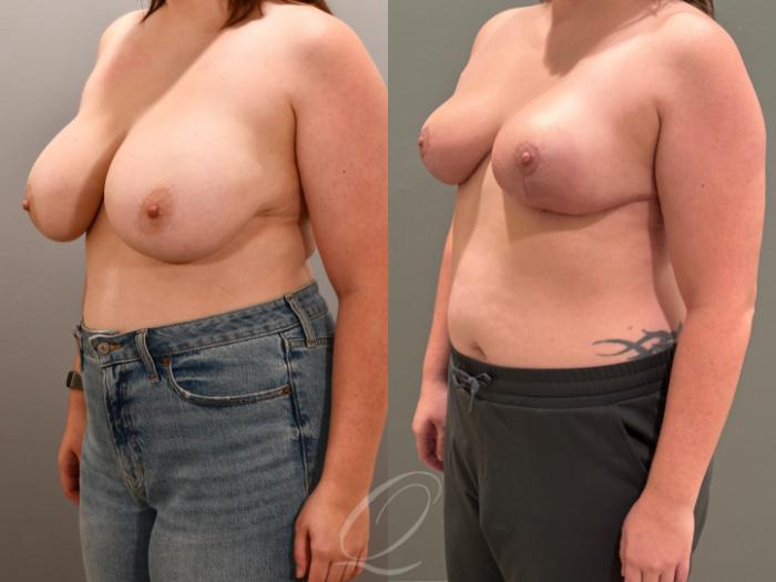 Breast Reduction Case 1001818 Before & After Left Oblique | Serving Rochester, Syracuse & Buffalo, NY | Quatela Center for Plastic Surgery