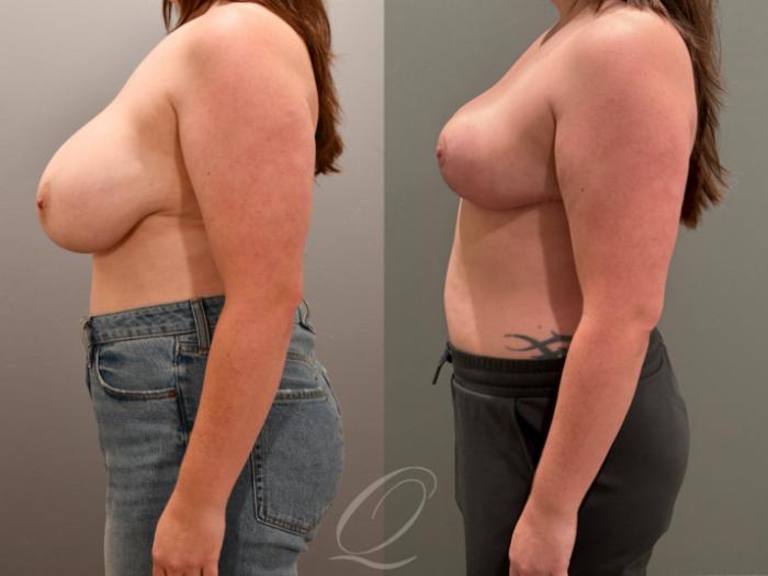 Breast Reduction Case 1001818 Before & After Left Side | Serving Rochester, Syracuse & Buffalo, NY | Quatela Center for Plastic Surgery