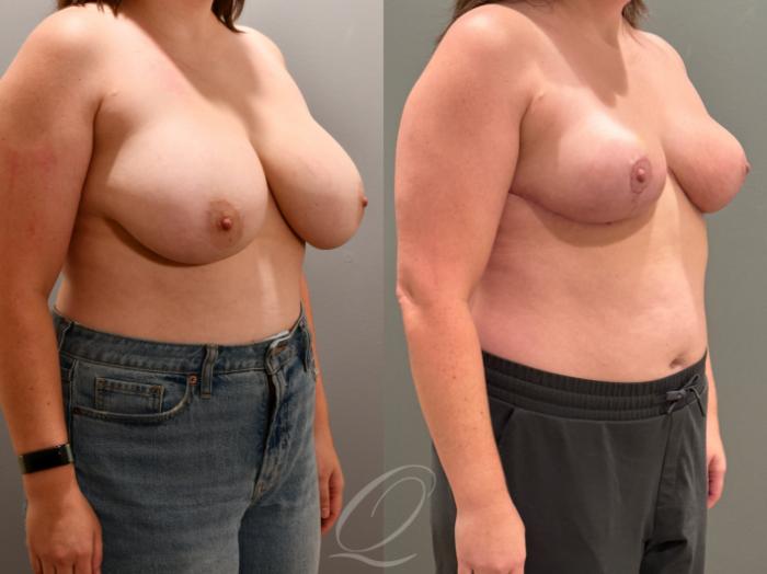 Breast Reduction Case 1001818 Before & After Right Oblique | Serving Rochester, Syracuse & Buffalo, NY | Quatela Center for Plastic Surgery