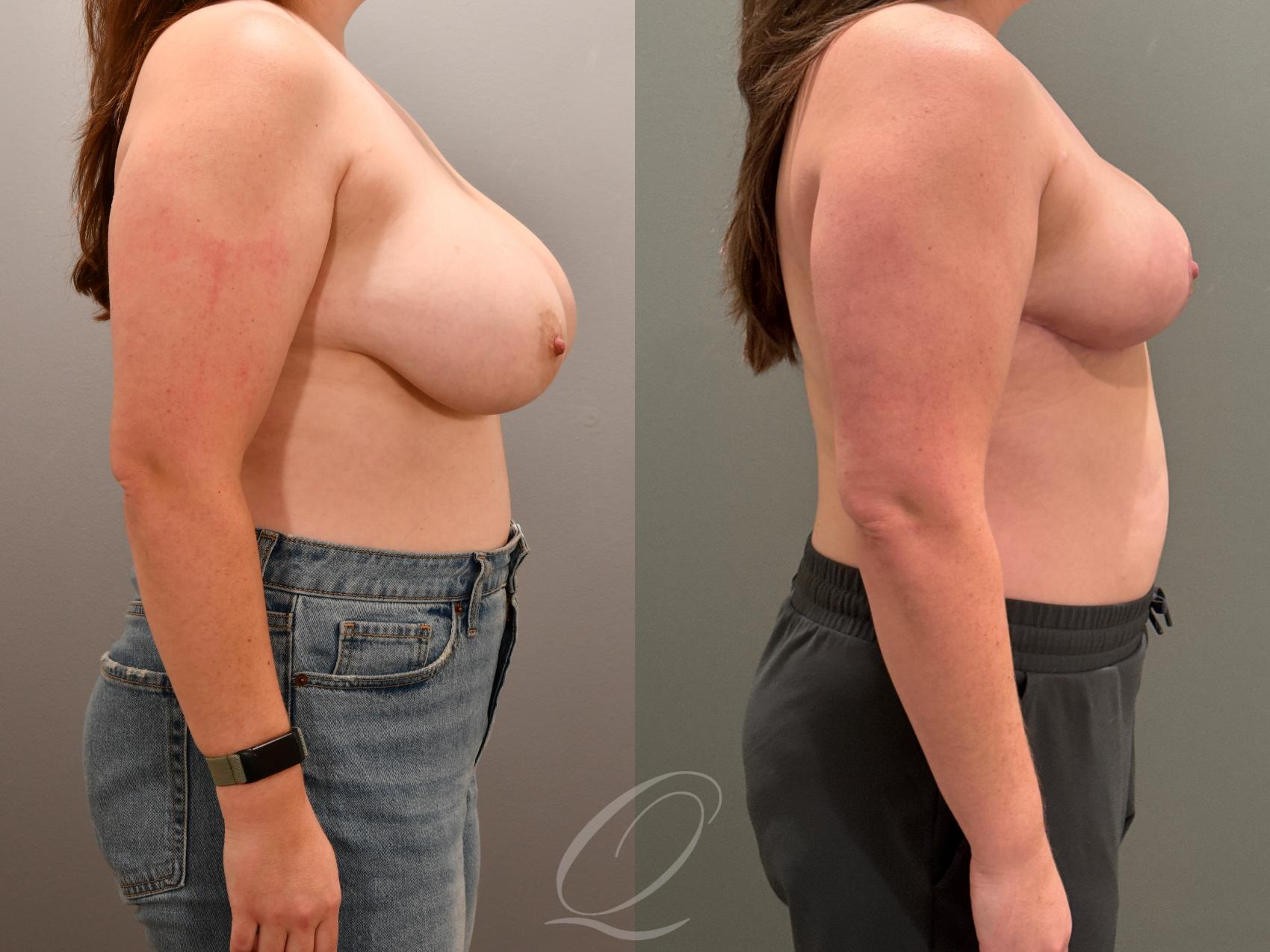 Breast Reduction Case 1001818 Before & After Right Side | Serving Rochester, Syracuse & Buffalo, NY | Quatela Center for Plastic Surgery