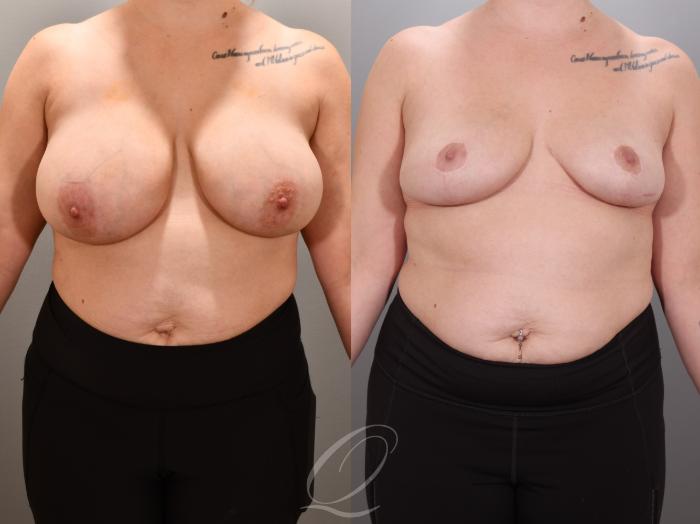 Breast Reduction Case 1001924 Before & After Front | Serving Rochester, Syracuse & Buffalo, NY | Quatela Center for Plastic Surgery